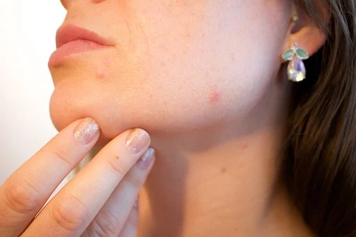 Is Acupuncture Helpful in Treating Acne Problems?