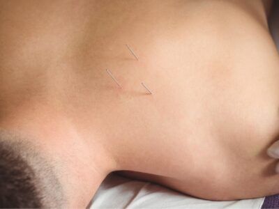 Acupuncture For Pain in El Cerrito