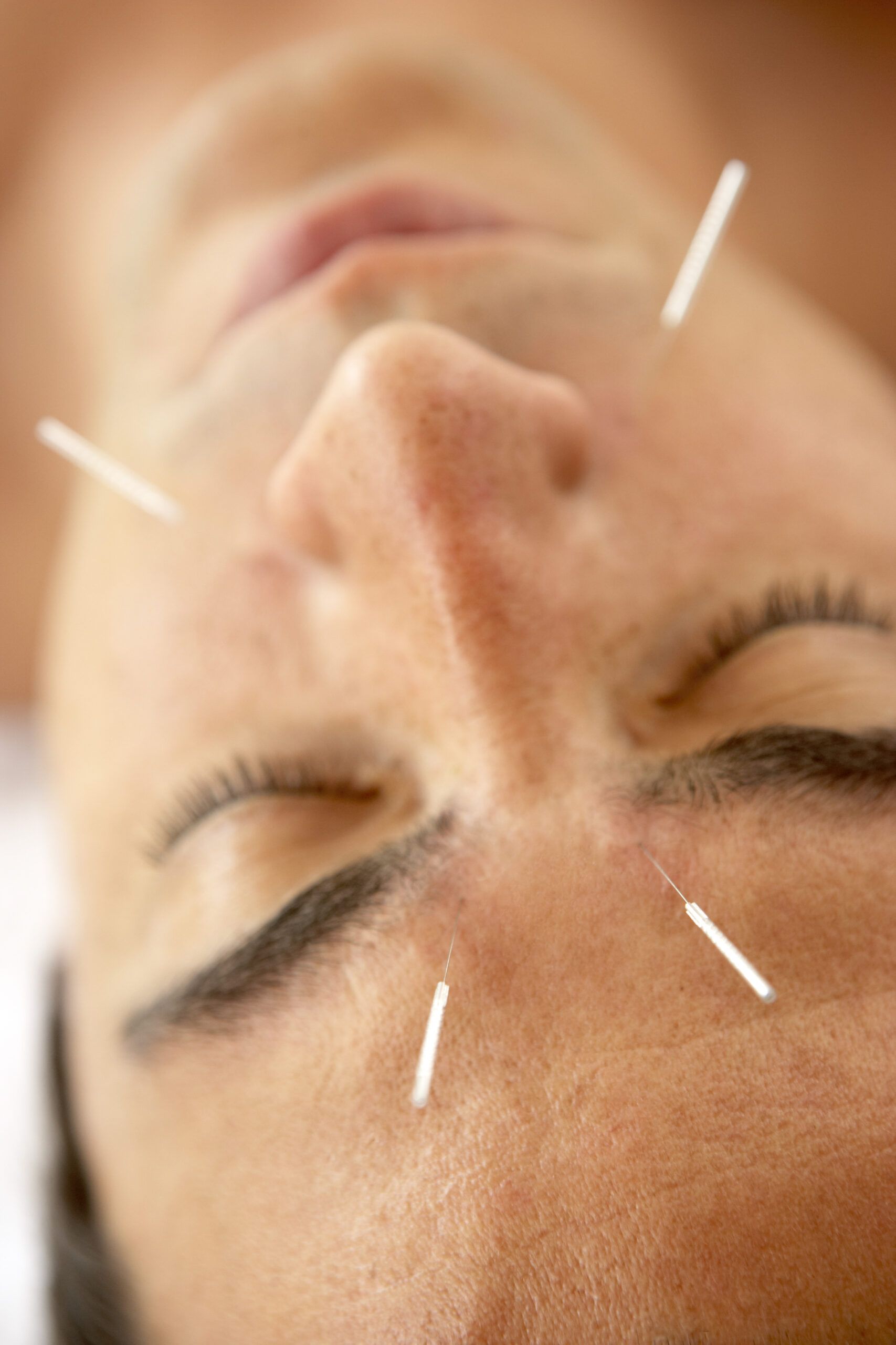 A person with several acupuncture needles in their face